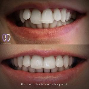 اصلاح-دندان-4