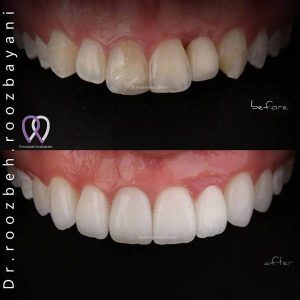 Teeth-bleaching-2