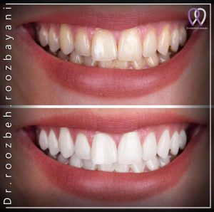 Teeth-bleaching-3