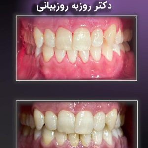Tooth-polishing-4