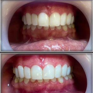 Tooth-polishing-5
