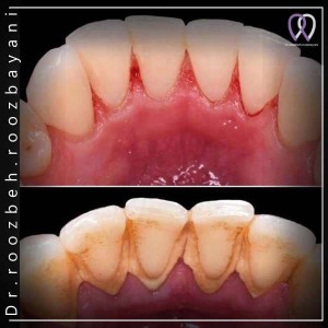Tooth-polishing-7