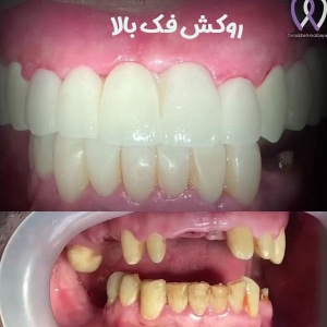 Dental-veneers-6