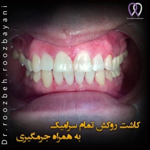 Dental-veneers5