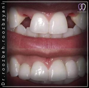 ایمپلنت-دندان-2