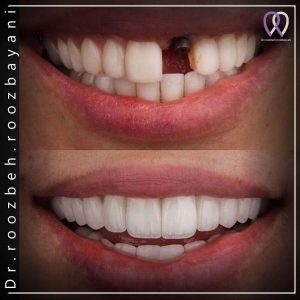 ایمپلنت-دندان-3