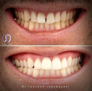 Dental-laminate-10