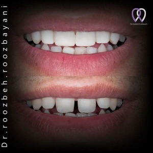 Dental-laminate-9