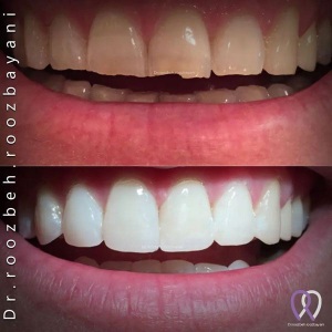Dental-composit-28