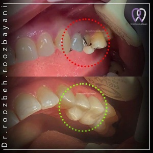 Dental-composite-23