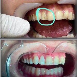 Dental-composite-24