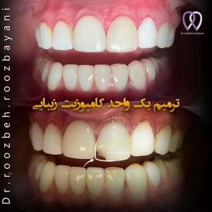 Dental-composite-26