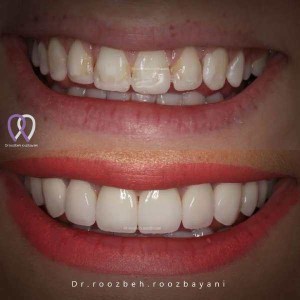 Dental-composite-38