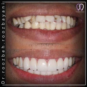 Dental-composite-39