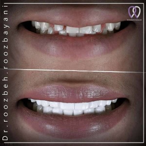 Dental-composite-40
