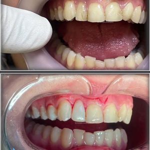 Dental-composite.-25