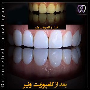 Dental-composite21