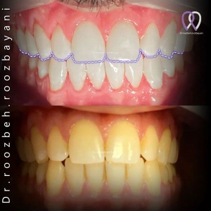 Dental-composite22