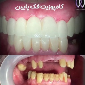 Dental-composite29