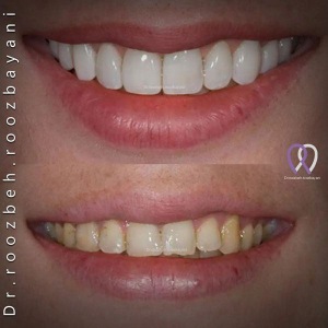 Dental-composite30