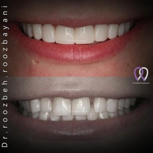 Dental-composite31