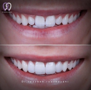 Dental-composite32