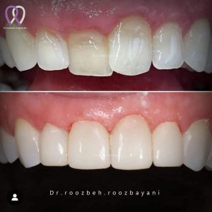 Dental-composite33