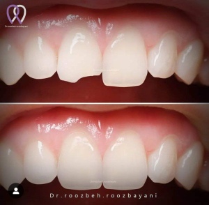 Dental-composite34