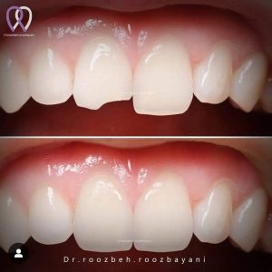 Dental-composite34