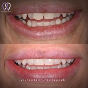 Dental-composite35