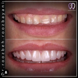 Dental-composite36