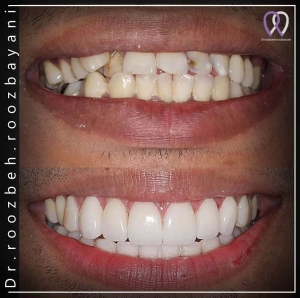 Dental-composite37