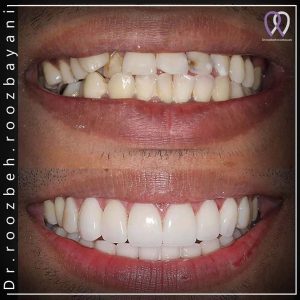 Dental-composite37