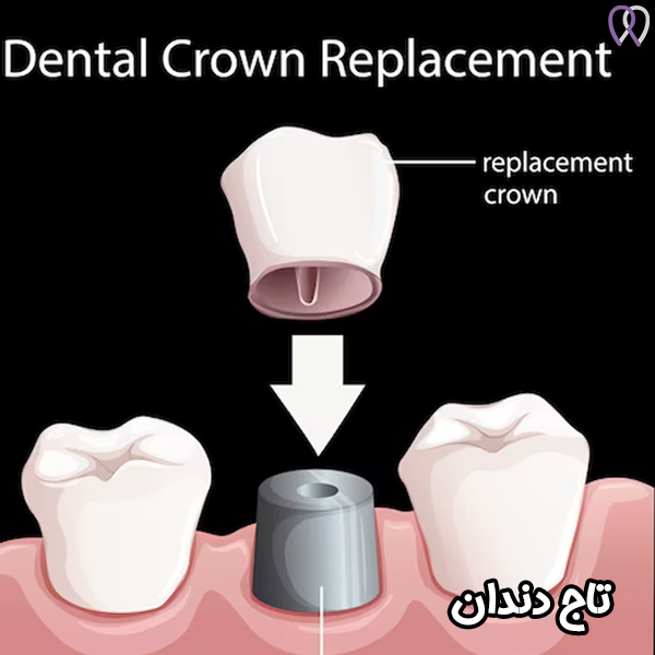 تاج دندان