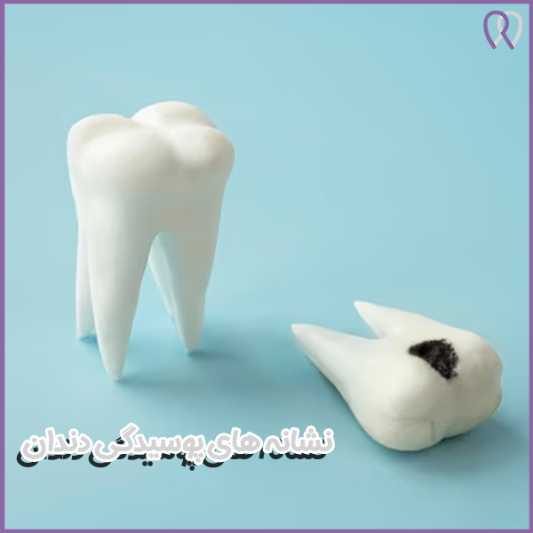 پوسیدگی دندان - دکتر روزبه روزبیانی