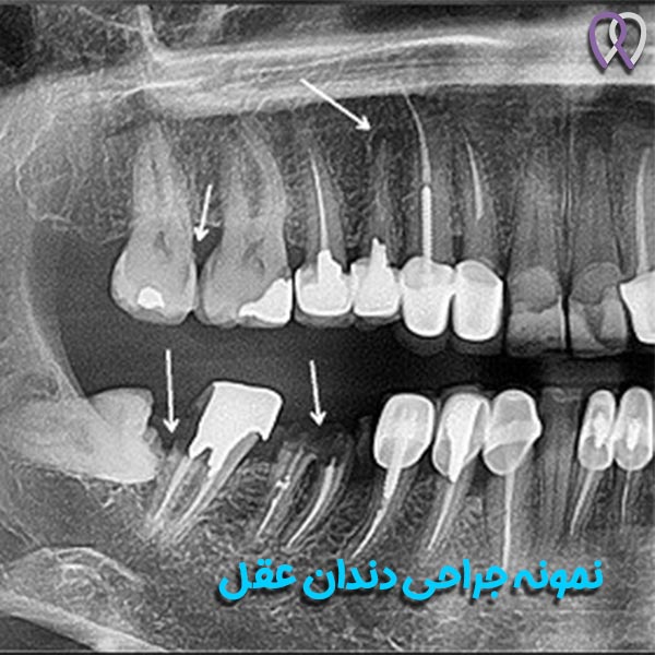 دندان عقل - دکتر روزبه روزبیانی