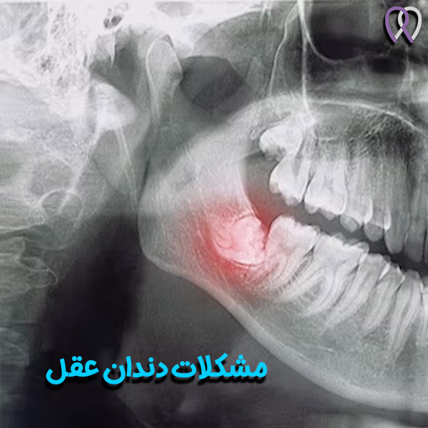 دندان عقل - دکتر روزبه روزبیانی