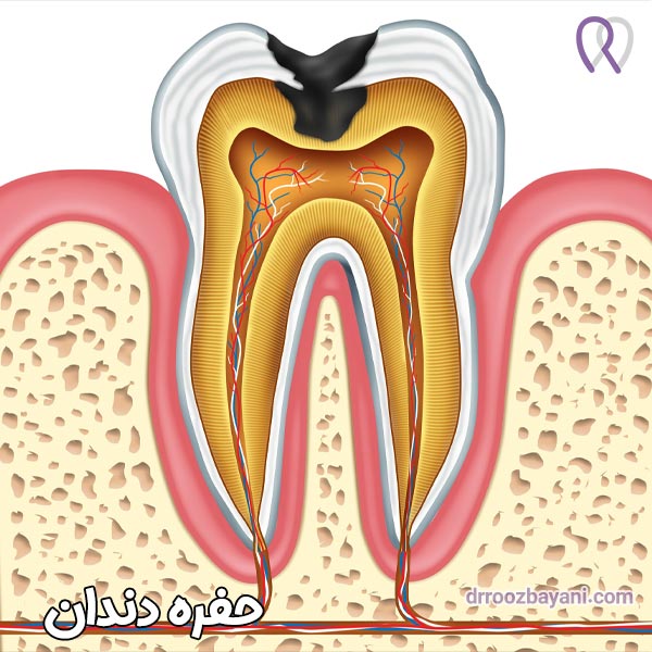 حفره دندان - دکتر روزبه روزبیانی