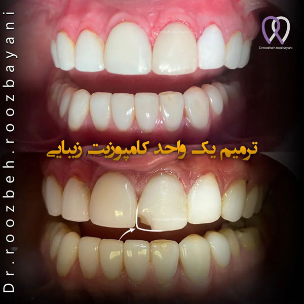 کامپوزیت دندان دکتر روزبه روزبیانی در تهران