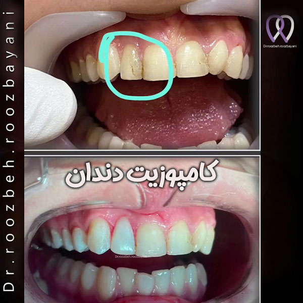 کامپوزیت دندان دکتر روزبیانی در تهران