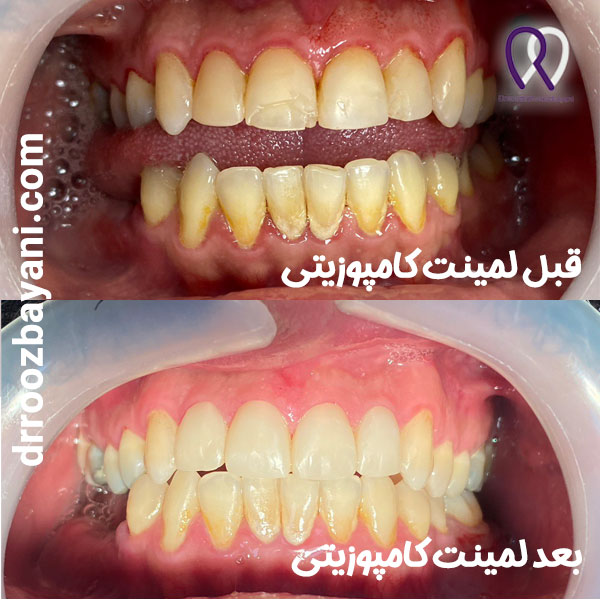 نمونه کار لمینت کامپوزیتی یکی از انواع لمینیت دندان