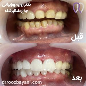 نمونه کار لمینیت دندان