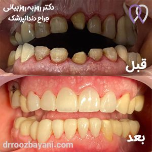 تصویر نمونه کار لمینیت دندان