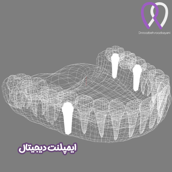 ایمپلنت دیجیتال