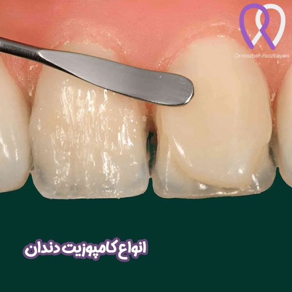 انواع مختلف کامپوزیت های دندان