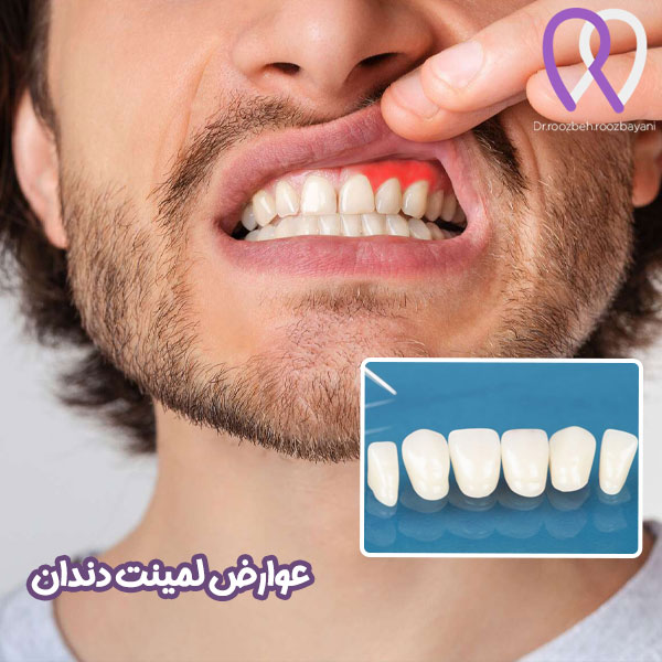 عوارض لمینت دندان