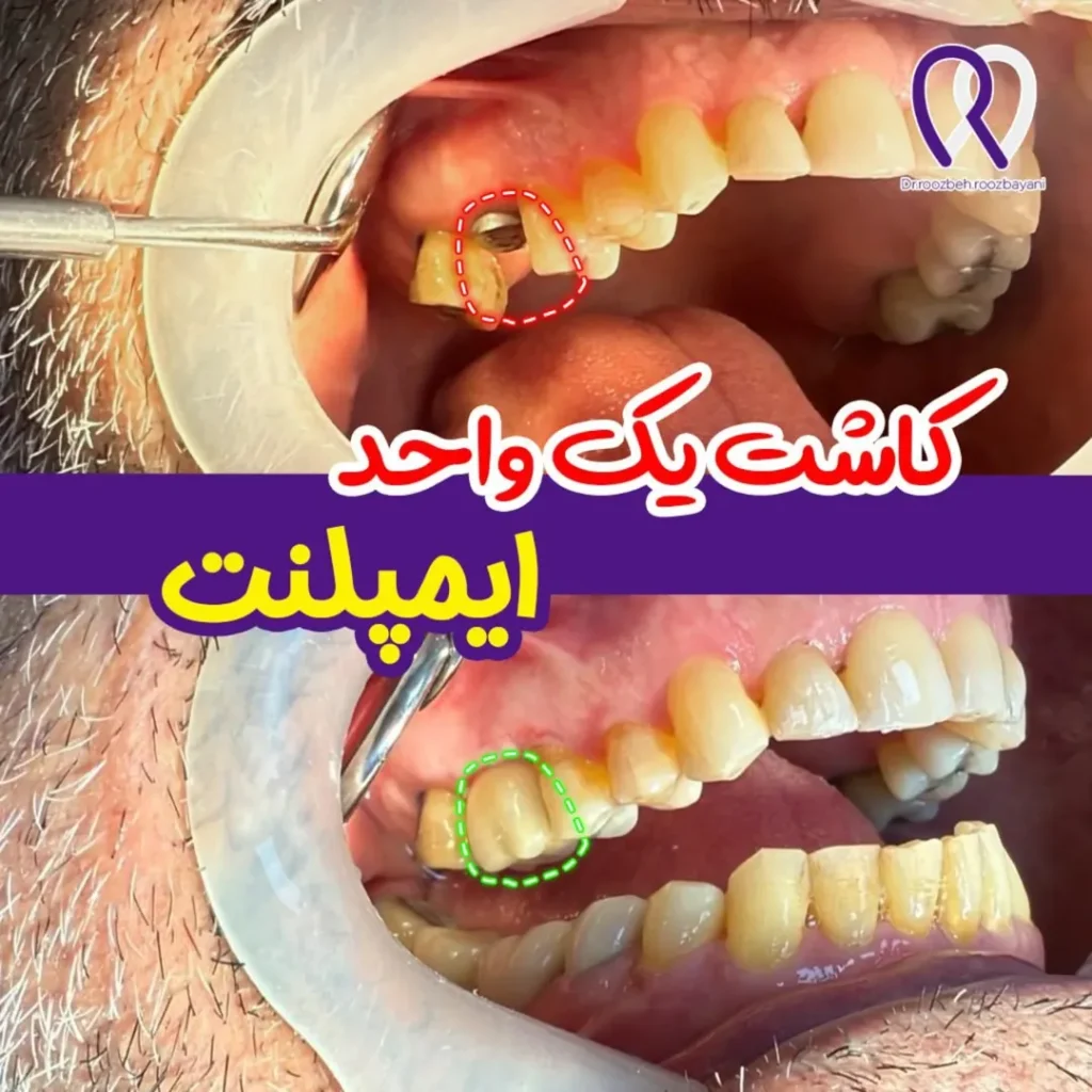 عکس نمونه ایمپلنت دیجیتال