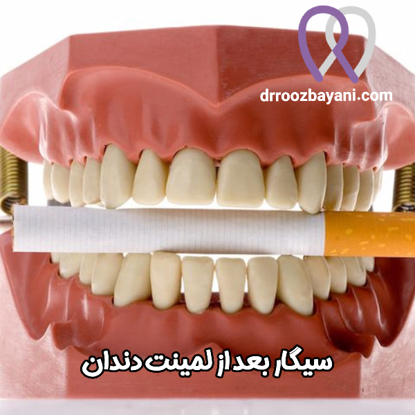 سیگار بعد از لمینت دندان - دکتر روزبه روز بیانی https://drroozbayani.com/