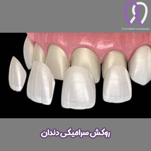 روکش سرامیکی دندان