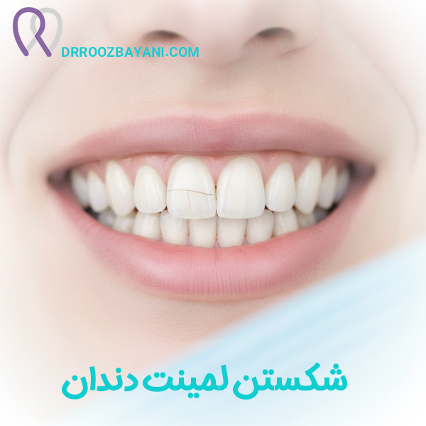 شکستن لمینت دندان - دکتر روزبیانی